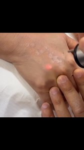 18 reactions | - Hands Pigmentation Laser erbium yag- It safely and...
