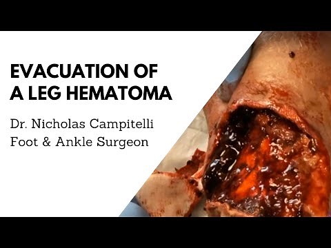 Surgical evacuation of a hematoma in a leg | Dr. Nicholas A. Campitelli