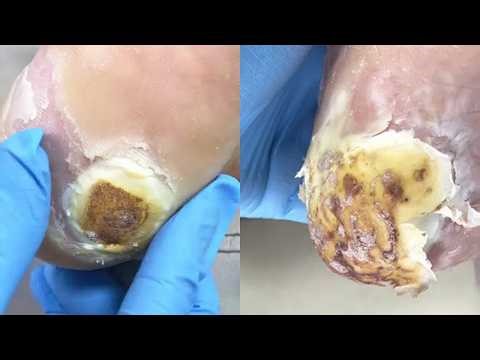 What Does This Plantar Wart Look Like Dare To Use Your Imagination【Pedicure Master Lin Jun】
