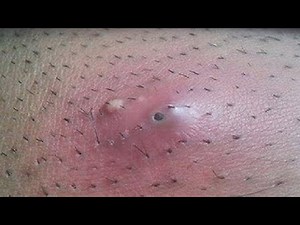 HOW TO GET RID OF INGROWN HAIRS INSANE