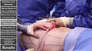 Surgical Removal of Illegal Silicone Buttock Injections with a Buttock Lift -AKA Posterior Body Lift