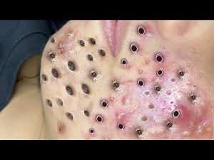 loan nguyen acne & spa 32