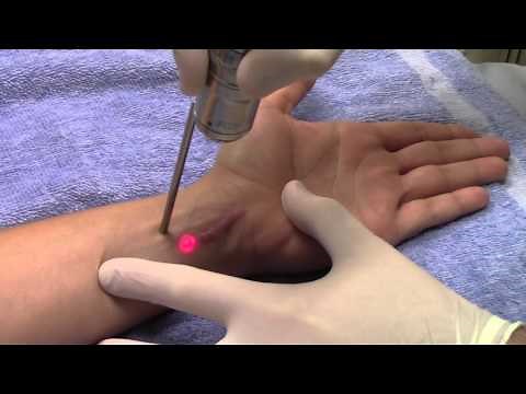Dr. Seiler performs scar revision with his Fotana Q-Switch Laser