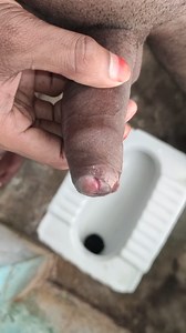 Penis peyronies and phimosis