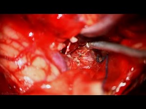 Suboccipital Craniotomy for Resection of a Medullary Hemangioblastoma