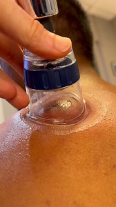 🏆 Cupping therapy uses suction to lift and decompress layers of fascia and muscle, helping improve blood flow, reduce stiffness, and ease deep muscle tension. Great for recovery and stress relief—sometimes you need to pull to release. #CuppingTherapy #MyofascialRelease #ChicagoChiropractic #Chiropractor #drkyleross | Dr_kyleross