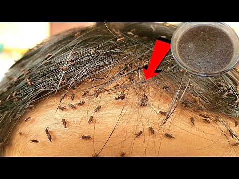 How to Remove lice eggs and lice in hair permanently