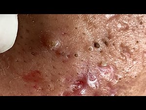 Make your Acne Treatment Huong Da Nang | 467# acne 2022