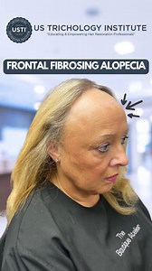 The Receding Mystery of Frontal Fibrosing Alopecia . . . #HairLoss #Alopecia #HairTransplant #HairGrowth #ThinningHair #HairRestoration #Baldness #HairLossTreatment #HairLossSolutions #Balding | United States Trichology Institute | Facebook