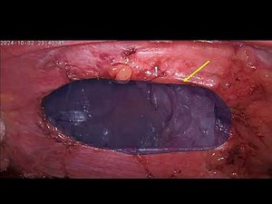 Laparoscopic mesh repair of diaphgragmatic hernia(Morgagni) by Dr Rashesh Solanki