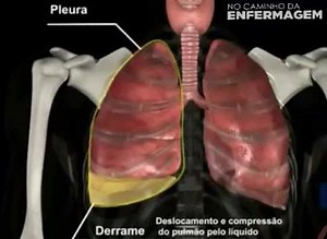 23K views · 517 reactions | O derrame pleural é o acúmulo anormal de líquido na cavidade pleural, que é o espaço virtual entre as pleuras visceral e parietal, as quais deslizam uma sobre a outra, separadas por uma fina película de líquido. | No Caminho da Enfermagem | Facebook