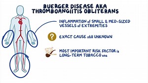 Video: Buerger disease: Year of the Zebra - Video Explanation! | Osmosis | Osmosis