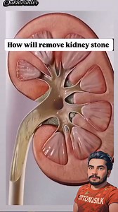 307K views · 2.7K reactions | Gallbladder stone and kidney stones | Sukhwinder Singh | Facebook