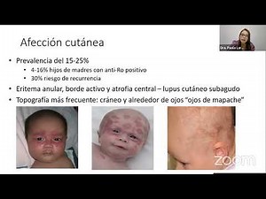 LUPUS NEONATAL