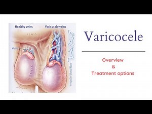 Varicocele - Overview and Best Treatment Options