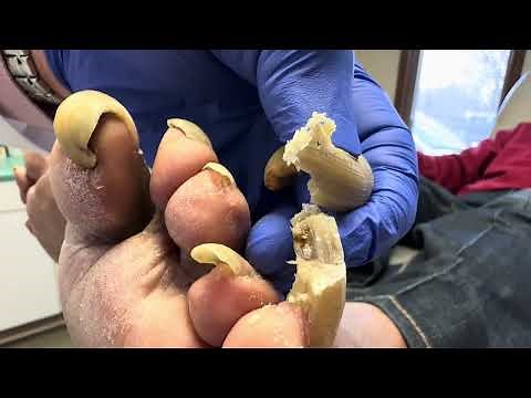 Unbelievable! Toenails so long and painful that patient cannot walk!