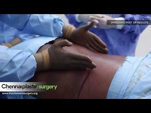 Lower Back Liposuction & Liposuction of Flanks (Love Handle) - Dr.Karthik Ram, Chennai (India)