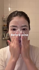 Effective Ingredients for Acne: Salicylic Acid, Benzoyl Peroxide & Retinoids