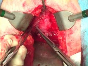 Radical Prostatectomy - Perineal Access • Video • MEDtube.net
