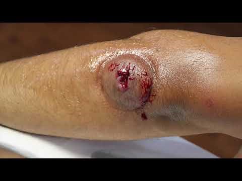 Cupping (Hijama) Therapy After WORM Comes Out From Insect Bite!