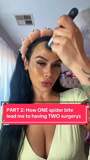 Part 2: Spider Bite Surgery Experience in Australia