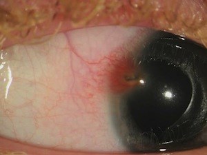 Corneal Foreign Body Extraction - Eyetube