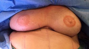 Breast Surgery Revision: The Doctor Shares 2 Examples