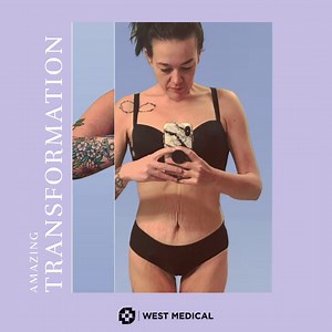 1K views | ★★⁠⁠ PROCEDURE: VERTICAL SLEEVE GASTRECTOMY (VSG) ★★⁠⁠ ⁠⁠....