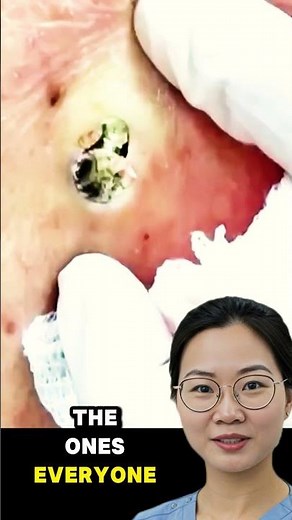 GIANT Blackhead Removal 😱 | Dilated Pore of Winer Extraction | Satisfying Skincare ASMR