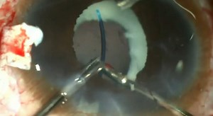 Aphakia With Microcornea - Eyetube