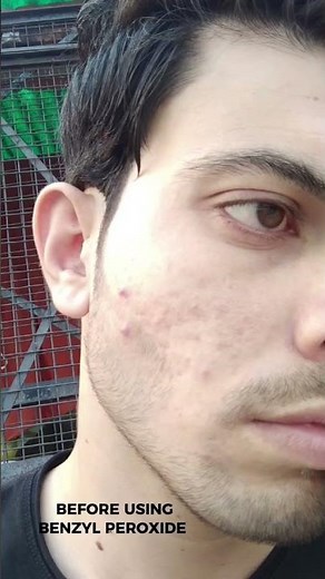 Side Effects Of Benzyl Peroxide And Acnestar Gel 😭🥺 #shorts #acne #skincare
