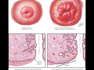 Erosion of the Cervix, Cervical erosion, cervical ectropion; glandular cells from inside spread