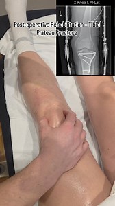 Post-operative Rehabilitation – Tibial Plateau Fracture (ORIF) 42-year-old patient, status post left tibial plateau fracture treated with open reduction and internal fixation. Following orthopaedic review and imaging confirmation of stability, we are now progressing into the rehabilitation phase. Goals: • Restore knee range of motion • Improve quadriceps control • Gradual load progression • Gait re-education • Reduce swelling & pain • Prevent long-term stiffness and compensatory patterns Rehabil