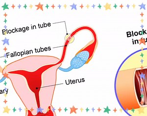 WHAT'S ARE SOME OF THE CAUSES OF BLOCKED FALLOPIAN TUBES? Blocked fallopian tubes, a common cause of female infɛrtility, are primarily caused by pelvic inflammatory dise@se (PID), endometriosis, and past surgeries, including ectopic pregnancies and tubal ligations These conditions can lead to scarring and adhesions that obstruct the tubes, preventing the egg and spɛrm from meeting. ELABORATION: Pelvic Inflammatory Disease (PID): PID is an infɛctions of the reproductive organs, often caused by sɛ