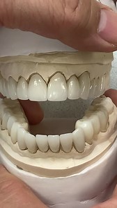 Absolutely stunning 25-Unit Restoration consisting of twelve Veneers, seven Crowns, and two Bridges! Case from Dr. Howard Abrahams in Florida. | LSK121 Oral Prosthetics