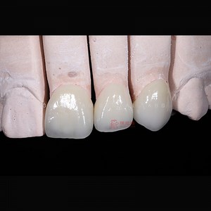 [Hot Item] High Quality Zirconia Dental Crown Made From Chinese Dental Laboratory for Dental Care