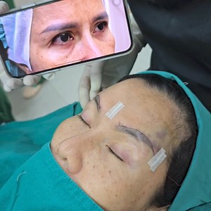 77 reactions · 8 comments | Direct brow Lift : คิ้วตก หางตาตก ไม่สดใส...