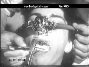 Dental Anaesthesia. Archive film 93804