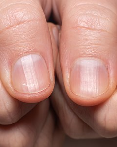 If You Have Ridges On Your #Fingernails It Means This | Glam