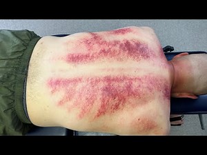 *Nerves On Fire* & One Of The *MOST* INFLAMED Spines I've Seen 😫 Helping SAVE Man's TOXIC Back