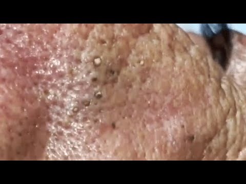 WOOW !! A PILE OF BLACKHEADS IN THE NOSE OF AN ELDERLY MAN😨 #relaxing #blackheads