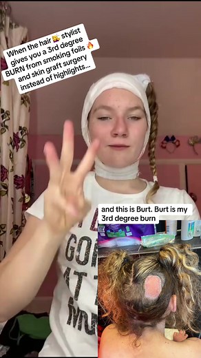 3rd Degree Burn from Smoking Foils: Hair Salon Horror Story