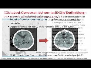 ICU Management of Subarachnoid Hemorrhage by Amedeo Merenda, MD