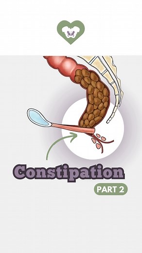 Dr. Julie Sarton & The Pelvic Healing Team on Instagram: "Part 2 Here’s a deeper look at how the body’s pooping mechanism works. The puborectalis muscle acts as a sphincter, maintaining continence by creating an angle that keeps stool within the rectum. Problems can happen if the puborectalis muscle is spasming and cannot relax when you’re ready for bowel movement. Straining and pushing against a tight puborectalis muscle can actually close off the rectum, making it harder for the stool to come