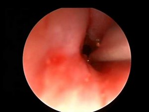 Treatment of Pediatric Subglottic Stenosis with the OmniGuide Flexible CO2 Laser Fiber