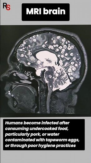 Neurocysticercosis (NCC) on MRI images #radiology #neurology #mri