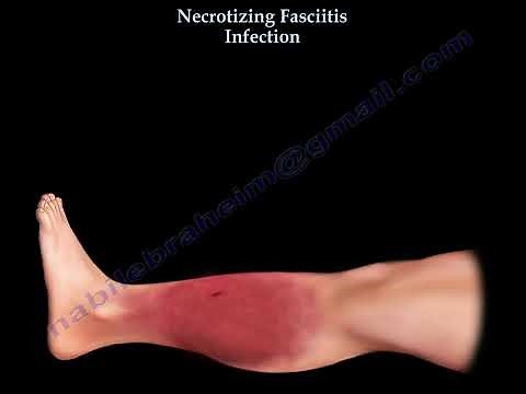 Necrotizing Fasciitis: Early Diagnosis and Treatment of Flesh-Eating Disease