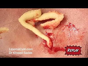 Face Cyst. Dr Khaled Sadek. LipomaCyst.com