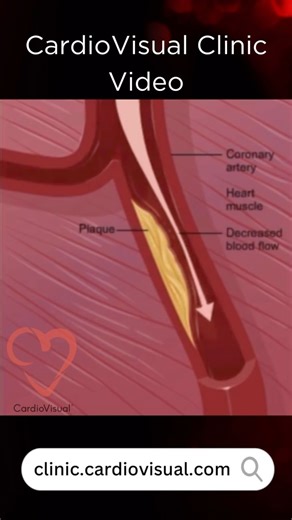 26K views · 51 reactions | Coronary Arteries and CAD (Coronary Artery...