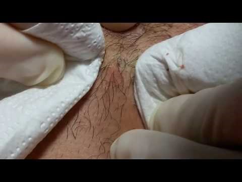 Severe Cystic Acne - Victor: Session #3